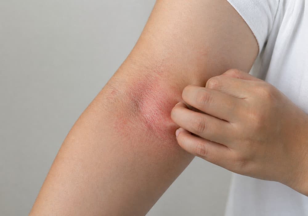 Eczema dermatitis on skin
