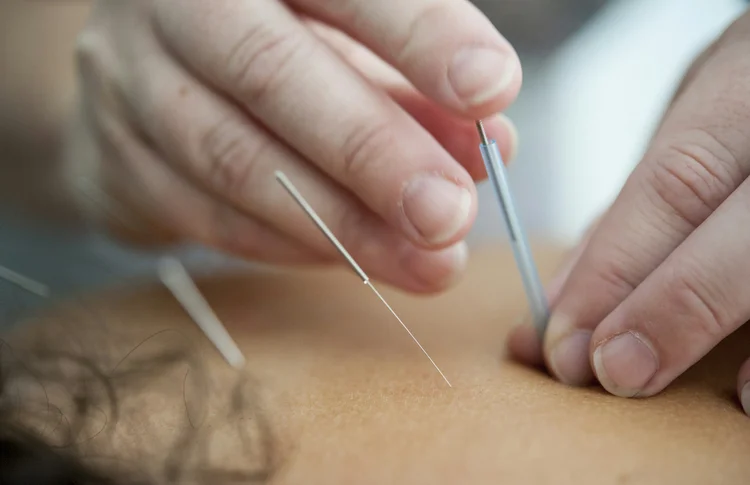 Acupuncture needles inserted during first treatment session