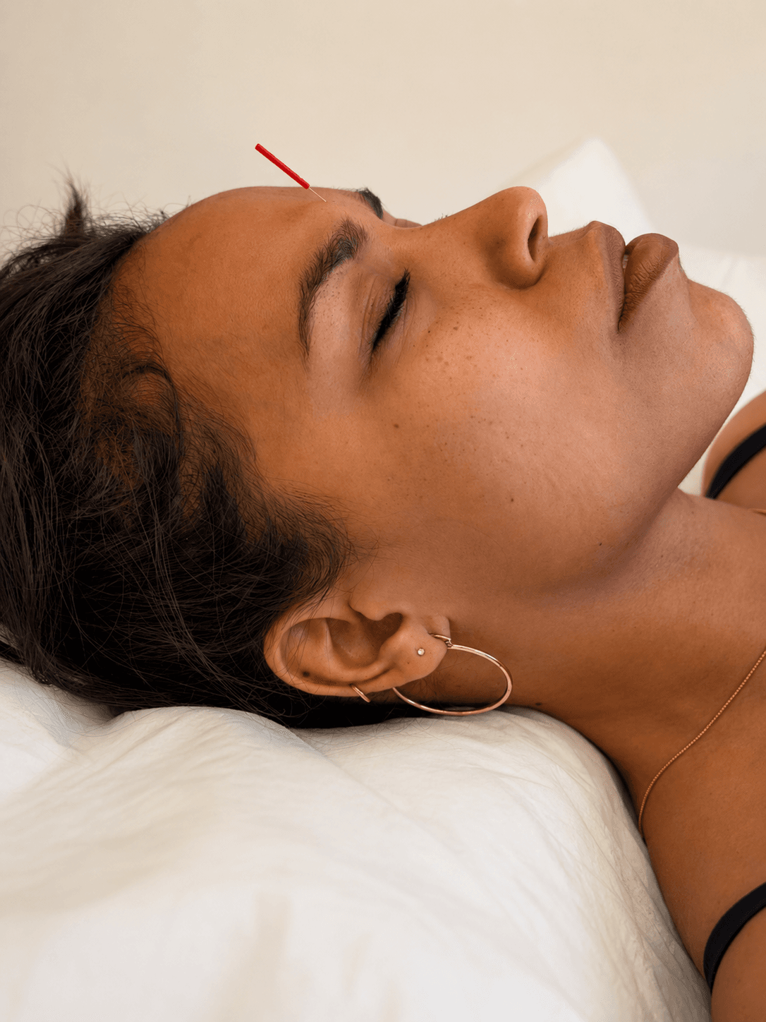 Patient receiving acupuncture treatment