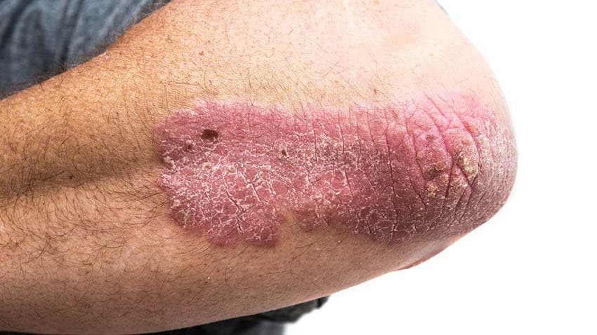 Plaque psoriasis affecting the elbow